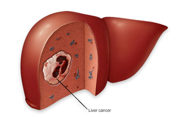 Cancer and Liver Damage